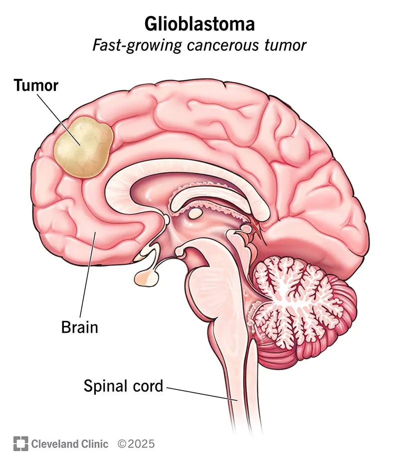 Glioblastoma