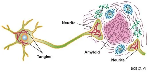 Патологические особенности болезни Альцгеймера